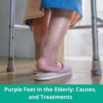 Purple Feet in the Elderly Causes, and Treatments